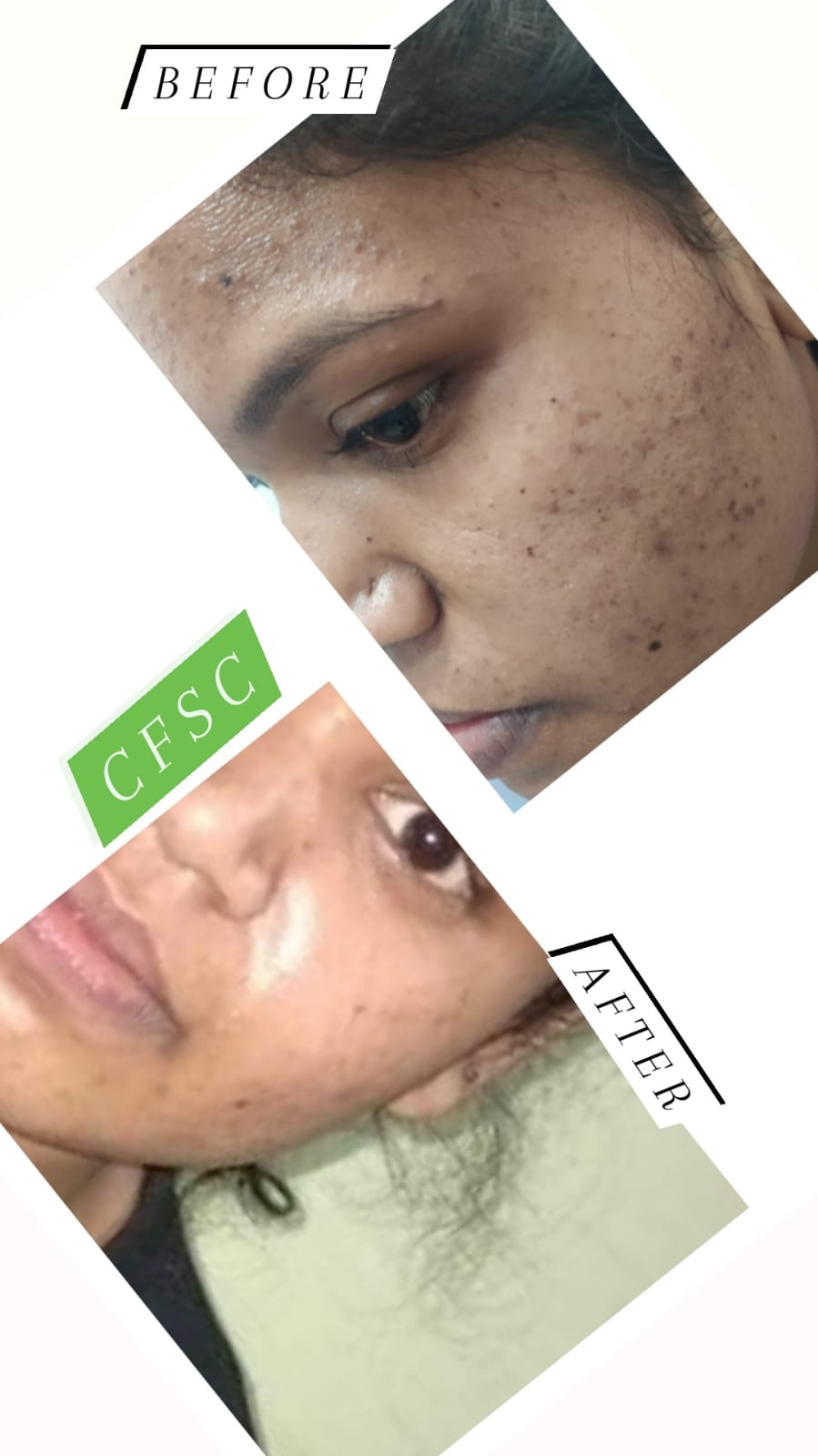 Before After Facial Treatment
